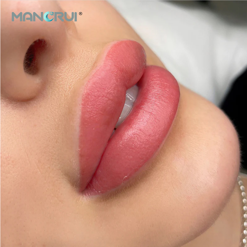 Derm 2ml Lip Filler, Normal lip plumping effect., for Marionette Line, Glabella lines (frown lines) , Mid-depth smile lines