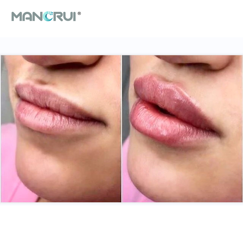 Derm 2ml Lip Filler, Normal lip plumping effect., for Marionette Line, Glabella lines (frown lines) , Mid-depth smile lines