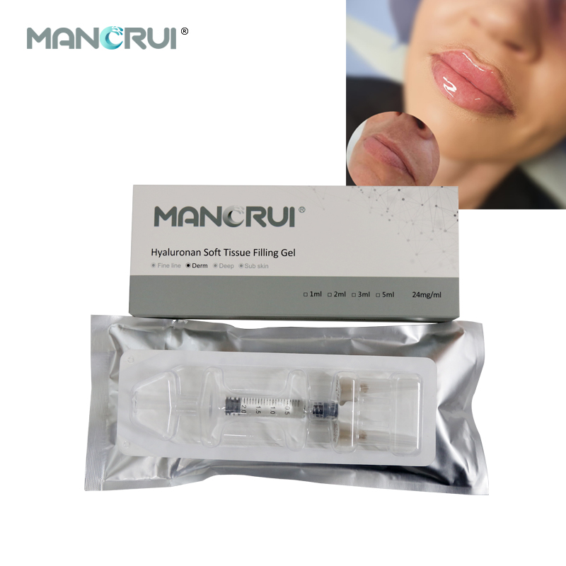Derm 2ml Lip Filler, Normal lip plumping effect., for Marionette Line, Glabella lines (frown lines) , Mid-depth smile lines