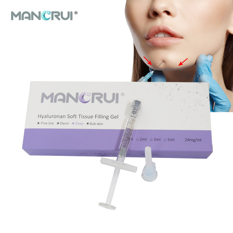 Deep 1ml Cross Linked Hyaluronic Acid Filler for Nose Shape, Chin Contour & Wrinkle Removal – Nasolabial, Marionette, Forehead Lines, Structural volume loss lines