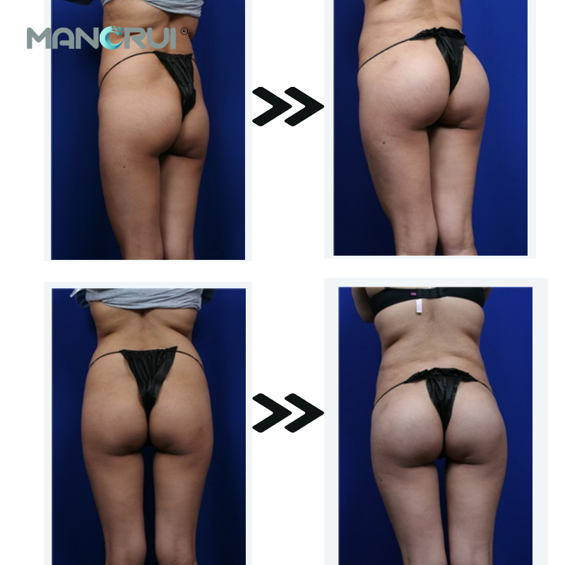 20ml breast hip enlargement buttock injection hyaluronic acid dermal filler for buttock