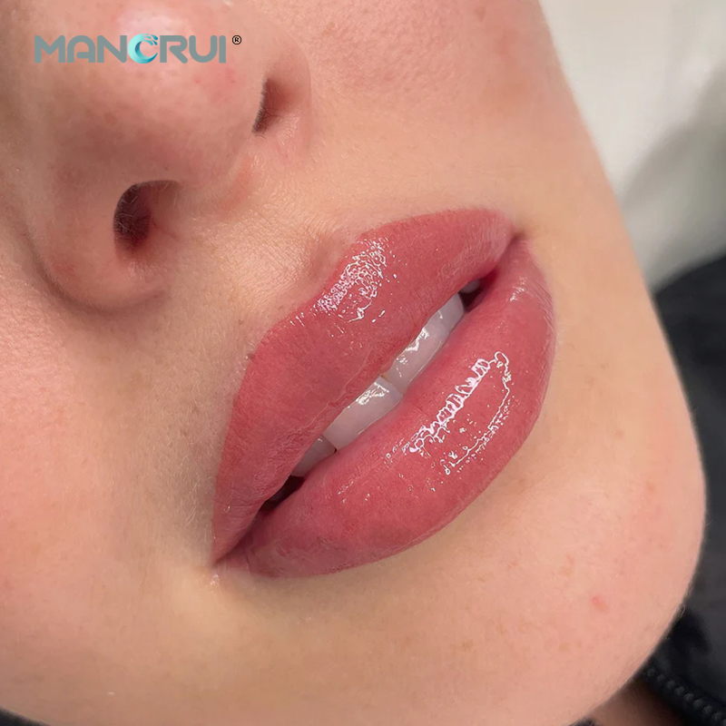 Derm 2ml Lip Filler, Normal lip plumping effect., for Marionette Line, Glabella lines (frown lines) , Mid-depth smile lines